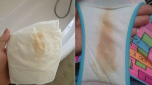 Белые выделения после постинора