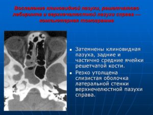 Утолщение слизистой в/ч, клеток решетчатого лабиринта