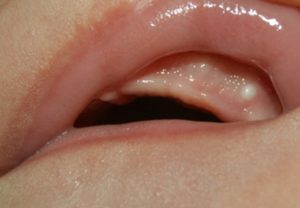 Белые бугорки на десне