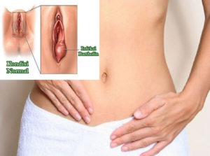 Опухает половая губа после секса