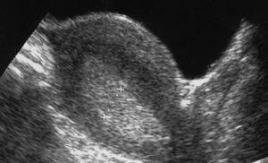 Узи гиперплазия эндометрия