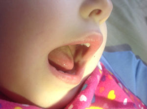 Блямба на внутренней стороне щеки