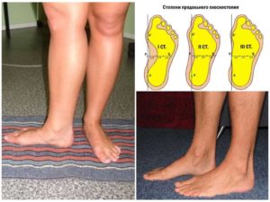 Инвалидность при плоскостопии