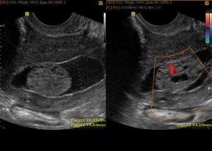 Рак шейки матки 3 степени по УЗИ