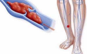 Тромбофлебит