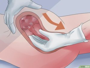 Выделения после установки пессария