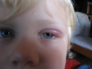 Припухло верхнее веко у ребенка