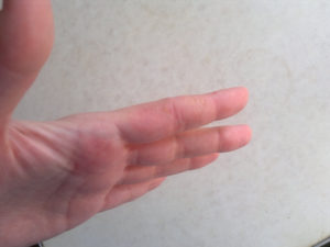 Подкожный шарик белого цвета на пальце