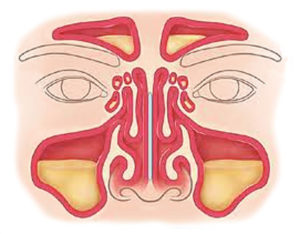 Головокружение после гайморита