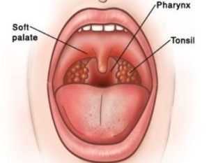 Пузырьки под миндалиной