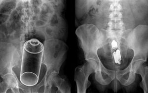 Застрял предмет в прямой кишке