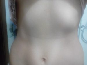 Опухоль на левой стороне ребер в низу