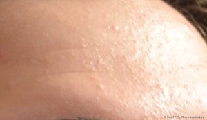 Бесцветная сыпь на лице
