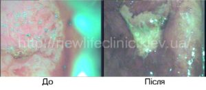 Обнаружили белое пятно на шейке матки