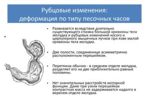 Желудок по типу песочных часов