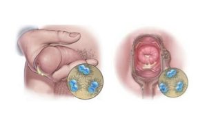 Возможно ли заразиться трихомонадой и гонореей через оральный секс?
