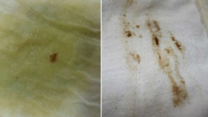 Мажущие выделения при дюфастоне, тупая боль внизу живота