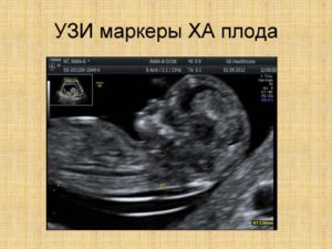 Эхо-маркеры ХА