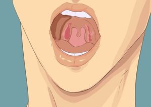 Поцарапала горло