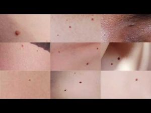 Образования в виде родинок на лобковой части тела