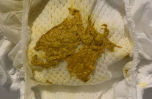 Частый Слизистый стул с белыми комочками на ИВ