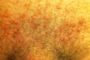 Краснота вокруг половых органов