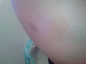 Пятно после синяка