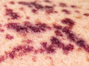 Геморрагическая сыпь при лейкозе