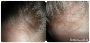 Красные пятна по линии роста волос на голове