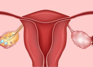 Не работают яичники