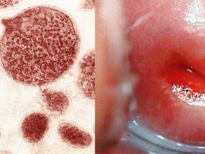 Выявили кандида и уреаплазма