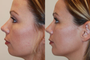 Осложнения после коррекции подбородка филлером