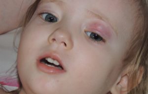 Припухло верхнее веко у ребенка