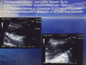 Утолщение стенок желудка