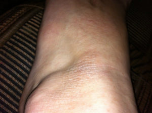 Сухая кожа на щиколотке возле косточки