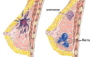 После замершей беременности уплотнение в верху левой молочной железы