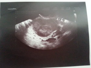 Жидкость в позадиматочном пространстве в первой половине цикла