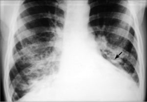 Просветы бронхов умеренно расширены, стенки незначительно уплотнены