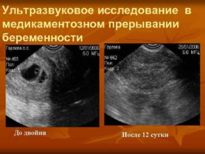 Посла фармаборта по узи остатки хориональной ткани