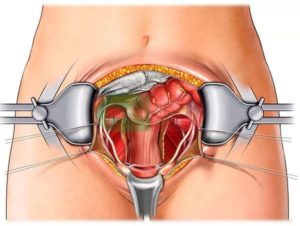 Тяжести после удаления матки