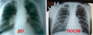 Спайки после пневмонии