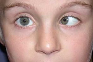 Глаз ушел внутрь