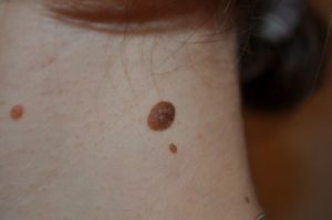 Родинка выпуклая на шее