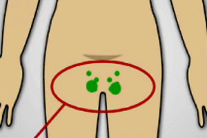 Прощупывается лимфоузел в паху