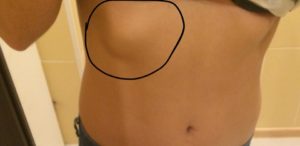 Шишка под правой грудью