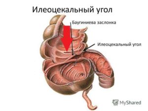 Недостаточность илеоцекального клапана