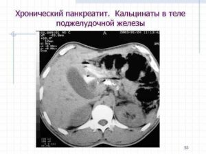 Что такое кальцинаты в поджелудочной до 3мм