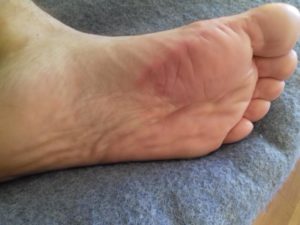 Потливость, сильно потеют ладони, ноги, пах, горят стопы