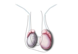 Увеличилось левое яичко