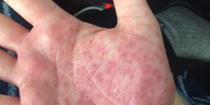 Сыпь на ладонях и ступнях
